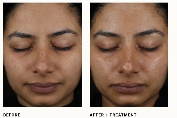 Skin Treatments in Surat