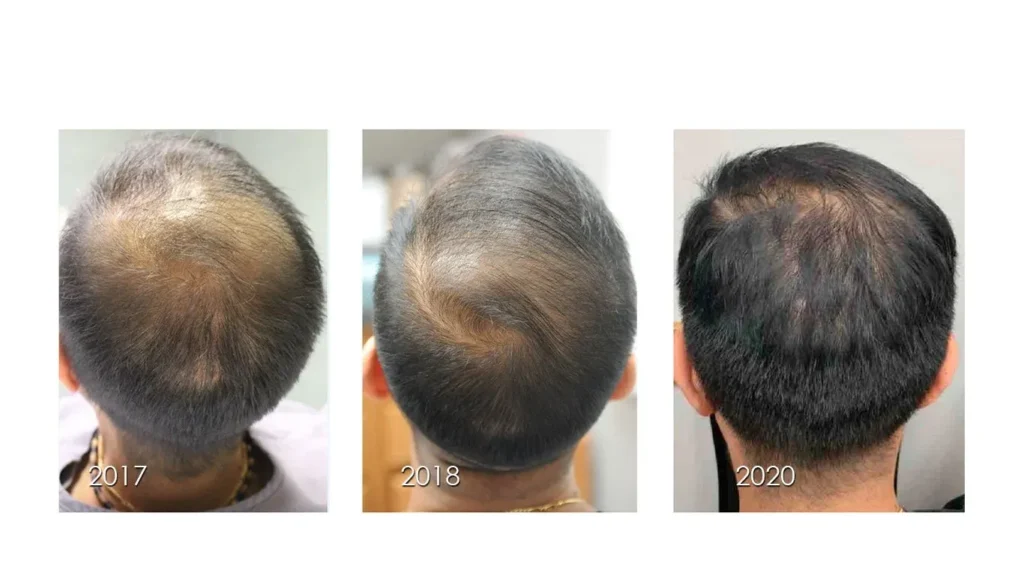 Before vs after Hair Regrowth Treatment