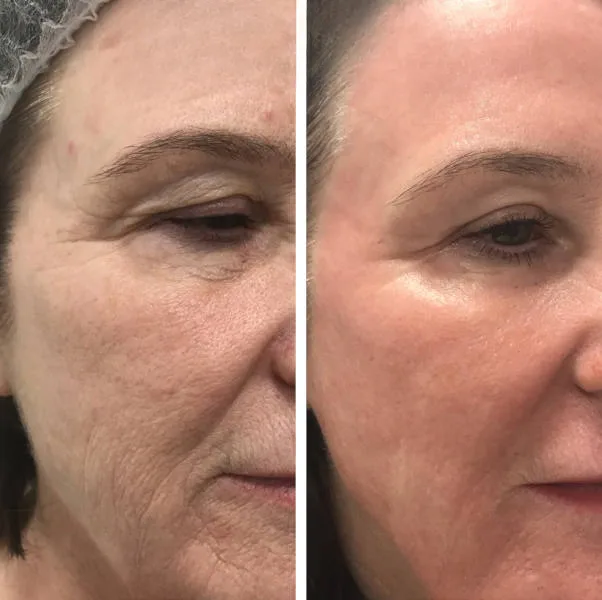 skin rejuvenation treatment