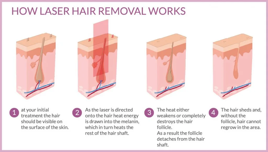 Laser Hair Removal process