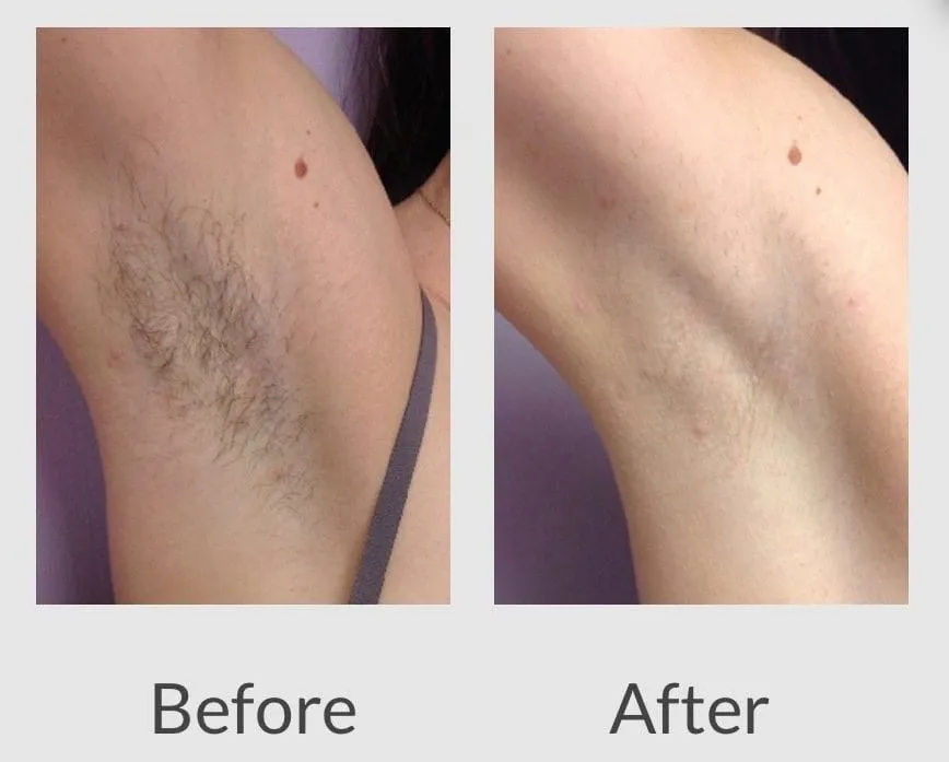Laser Hair Removal before vs after image Cleint review