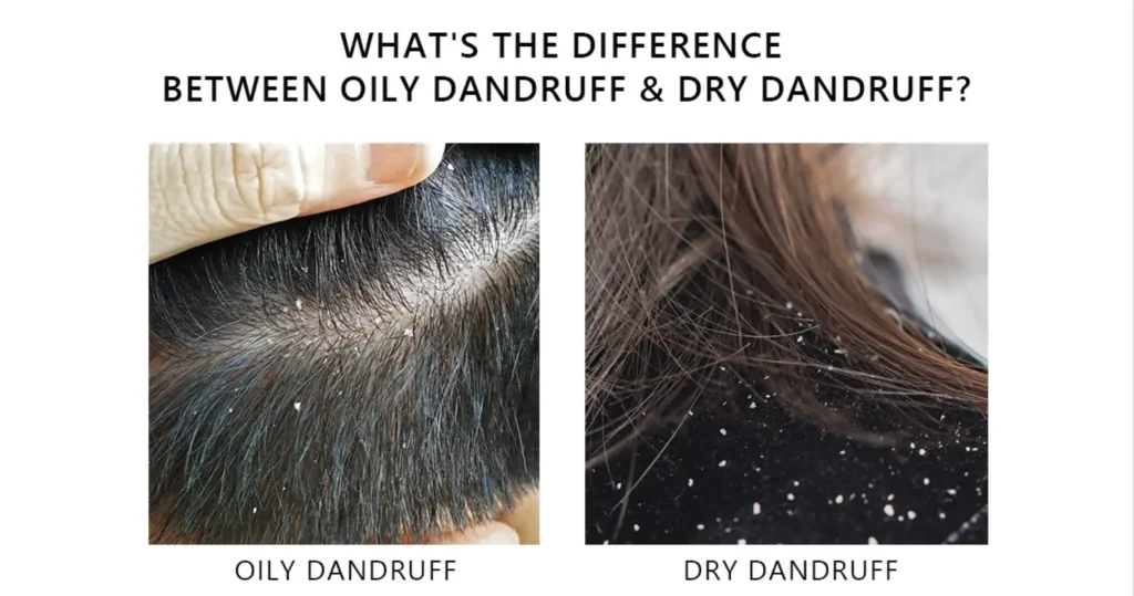Scalp Treatment for Dandruff