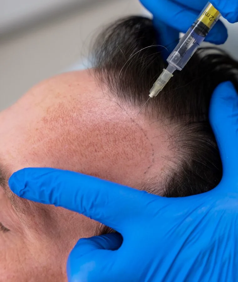 Hair Loss Treatments