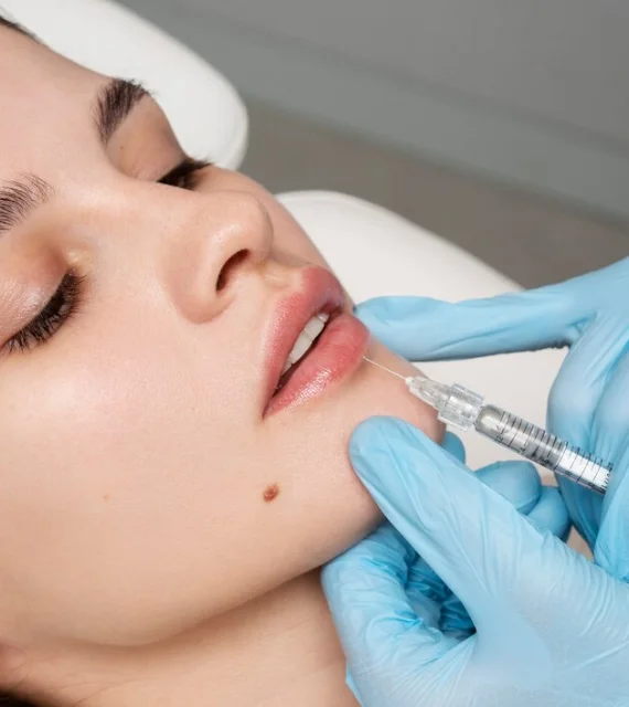 Lip Fillers