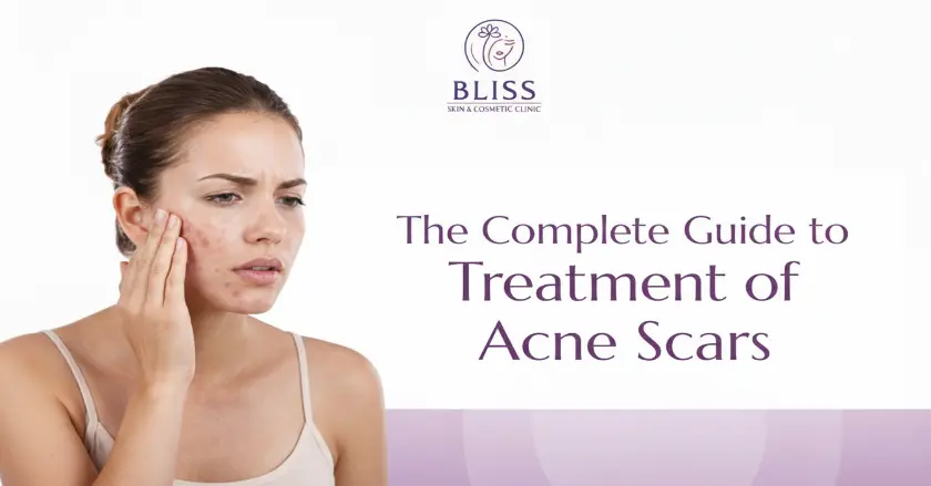 Acne Scar treatment