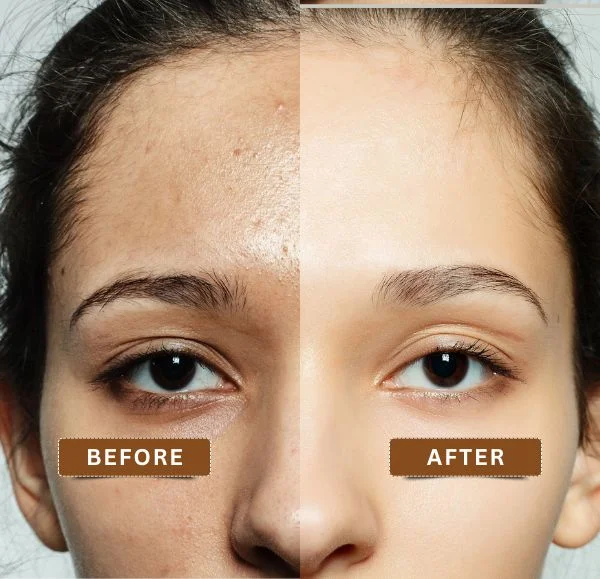 Advanced Hydrafacial