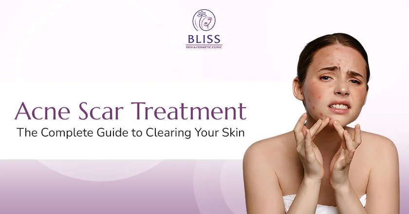 Acne Scar Treatment- The Complete Guide to Clearing Your Skin