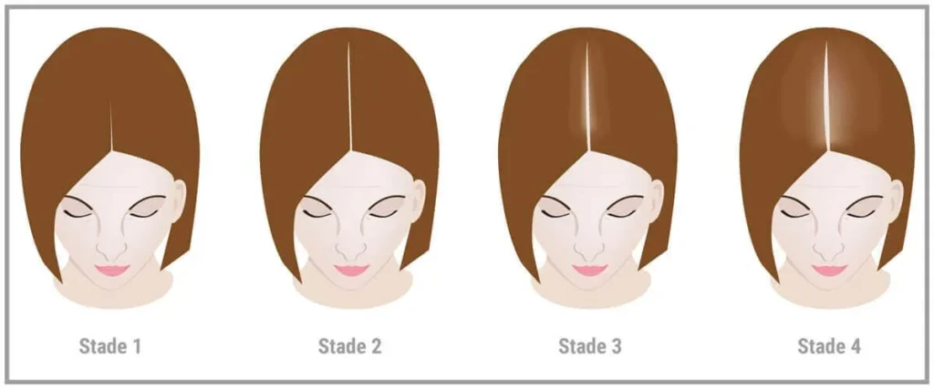 Hair Fall Treatment for Women