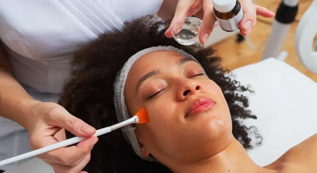 Chemical Peel